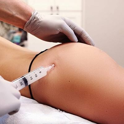 Butt Injections Abu Dhabi & Al Ain | Butt Filler Cost
