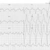 For moderate or severe hyperkalemia, iv insulin and glucose, an iv calcium solution, possibly an inhaled. 1