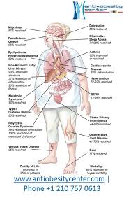 Benefits Of Bariatric Surgery Gastricbypasssurgerymexico Lapbandsurgerymexico Bariatricsurgerymexico Weightloss Health Fitness Healthy Weight Weight Loss