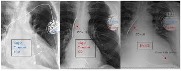 Anesthesia provider, surgeon, proceduralist or designee may place an order for icd / pacemaker procedural. Differentiating Pacemaker Vs Icd On Chest Xray Single Grepmed