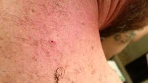 Jamie glover answered family medicine 22 years experience Video Pulling Out A 6 Year Old Ingrown Hair