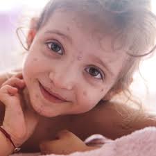 Rubella threat hasn't gone away you know