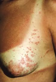 Image result for mite bites on humans