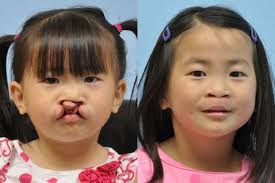 Cleft Lip Nose Repair Woodbury Mn Midwest Facial Plastic Surgery Cleft Lip Facial Plastic Facial Plastic Surgery