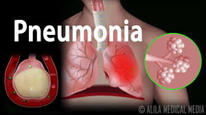 Symptoms typically include some combination of productive or dry cough, chest pain, fever and difficulty breathing. Pneumonia Animation Youtube