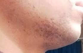 Next, press the warm washcloth over your ingrown hair for up to 15 minutes. Pin On Ingrown Hair On Vagina