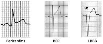 Salah satu kesulitan dalam interpretasi ekg digital adalah menghitung interval qt secara tepat. Jurus Mudah Cara Membaca Ekg Dasar Whitecoathunter
