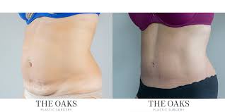 When medicaid covers vision [exams, eyewear. Houston Tummy Tuck Surgeons Abdominoplasty Houston Tops