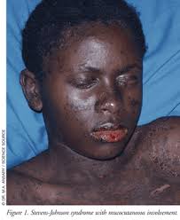 Stevens Johnson Syndrome What A Pharmacist Should Know