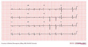 Sick Sinus Syndrome Ekg Examples Wikidoc