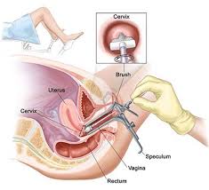 The pap test (or pap smear) looks for precancers, cell changes on the cervix that might become cervical cancer if they are not treated appropriately. Pap Smear Ob Gyn Pap Test Brooklyn Heights Nyc