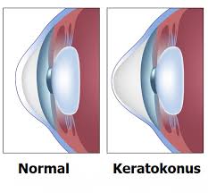 Keratokonus Universal Goz Hastanesi
