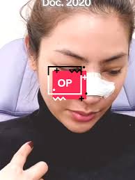 Faye Peraya Nose Before