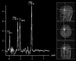 The cancer cells break away from the primary tumor and travel to the brain, usually through the bloodstream, then commonly go to the part of the brain called the cerebral hemispheres or to the cerebellum. Glioblastoma Multiforme Symptoms Diagnosis And Treatment Options