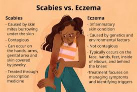 Image result for scabies symptoms