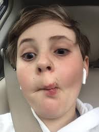 Normal eyes imperfect vision.