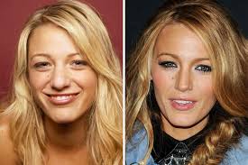 Hollywood Stars Before And After Plastic Surgery Celebrity Plastic Surgery Plastic Surgery Cosmetic Surgery