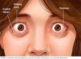 It frequently results in and is the most common cause of hyperthyroidism. Graves Disease Symptoms And Causes Mayo Clinic