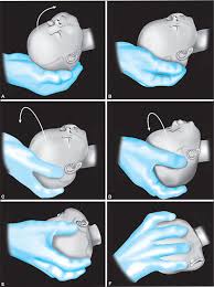 Image result for Manual Rotation in Occipitoposterior Presentation