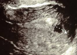 We did not find results for: 6 Week Ultrasound Pictures Twins And What To Expect Bellybelly