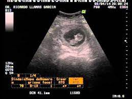 Ultrasonido 11 Semanas Youtube