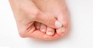 Remedios caseros hongo uña pie dedo gordo. Tienes Una Una Del Pie A Punto De Caerse O Se Ha Caido Ya Descubre Como Actuar Ante Estas Dos Situaciones Podoactiva Lideres En Podologia