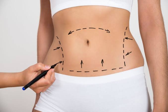 Liposuction in Islamabad | Expert Surgeon, Safe Procedure