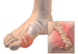 We included our favorite ways to take cbd for those who don't like the earthy hemp flavor the. Gout Prevention And Treatment With Cannabidiol Greenbridge Medical Family Medicine Physicians