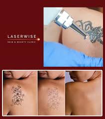 You can be sure that the procedure is safe, sterile and effective. Tattoo Removal Laserwise Skin Clinic