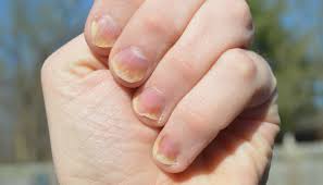 A psoríase nas unhas ou também conhecida como psoríase ungueal aparece como grandes pontilhados profundos aleatoriamente nas unhas. Unhas Podem Indicar Doencas Anemia Psoriase E Mais Vix
