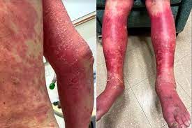A vacina contra a gripe é indicada para todas as pessoas a partir de 6 meses de vida, principalmente aquelas com maior risco para infecções. Idoso Tem Reacao Rara Apos Tomar Vacina Contra A Covid 19 Da Johnson Johnson Jovem Pan