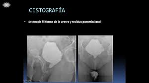 Al igual que con otros trastornos médicos, el proceso de diagnóstico para la estenosis espinal incluye una historia clínica completa del paciente y exámenes. Estenosis Uretral Femenina Colgajo Injerto O Marsupializacion Youtube