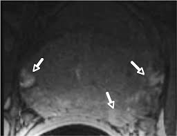 Stage 3 prostate cancer is an advanced but still treatable form of the disease. Mr Imaging In Local Staging Of Prostate Cancer European Journal Of Radiology
