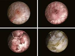 The first invisible sculpture sold for 15 thousand euros. Endoscopic Treatment Of Bladder Tumors Sciencedirect