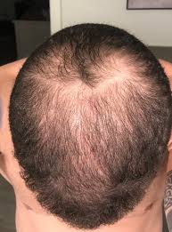 Diffuse hair loss causes a fairly even amount of shedding all over the scalp, making the hair appear thinner due to this excessive hair fall. Hair Transplant Surgery Archives Hair Loss Blog