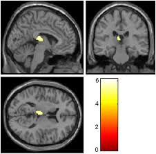 What color represents anxiety disorder. Plos One Childhood Maltreatment Is Associated With Larger Left Thalamic Gray Matter Volume In Adolescents With Generalized Anxiety Disorder