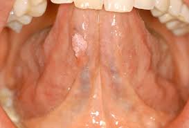 Image result for papillomavirus tongue)