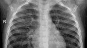 Image result for Pneumonia