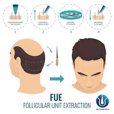 Oggi, il trapianto di capelli si può fare senza rasarsi che noi chiamiamo fue senza la . Trapianto Di Capelli Senza Rasatura Come Funziona In Turchia Newsbiella It