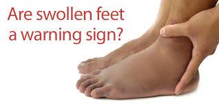 If airline passengers are not careful, they could be dealing with swollen feet and legs that can be exacerbated, possibly leading to complications. Safety Sedentariness And What Your Legs Are Telling You At Work By Terry Penney Linkedin