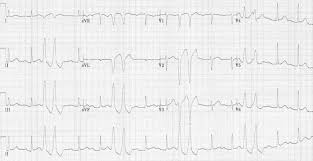 Premature Ventricular Complex Pvc Litfl Ecg Library Diagnosis