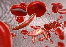 This is the protein in red blood cells that carries oxygen to all parts of the body. World Sickle Cell Day Brings Awareness To Sickle Cell Disease