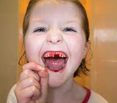 The following can help minimize discomfort, reduce the risk of infection, and speed recovery. Use Teabag To Stop Bleeding After Tooth Extraction