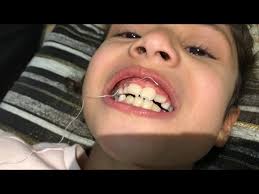 Ip Ile Dis Cekimi Tooth Extraction With Floss Youtube