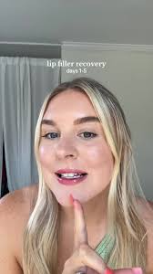 my lip filler journey 👄 #lipfiller #juvedermlips #cosmetic #makeup