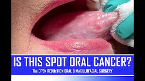 Image result for white cancer on tongue)