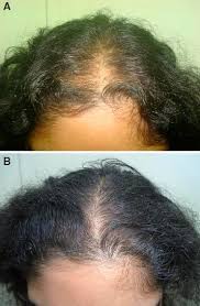 Vitamin d plays a role in the creation of new hair follicles. Controlled Clinical Trial For Evaluation Of Hair Growth With Low Dose Cyclical Nutrition Therapy In Men And Women Without The Use Of Finasteride