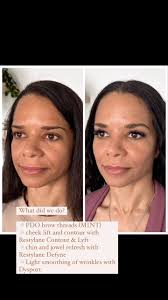 How’s this for an age rewind??, These are fully settled results of a full  face balancing (or should I say full face refresh) patient of ours. She’s  already done several sessions with us to get her to ...