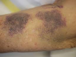 Even with wearing long sleeves while working outside, (today it was about 76 degrees by 8 am here), i still get poked or scratched. Senile Purpura Dermnet Nz