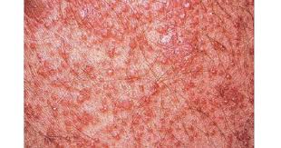 Pityriasis Rubra Pilaris Www Medicoapps Org